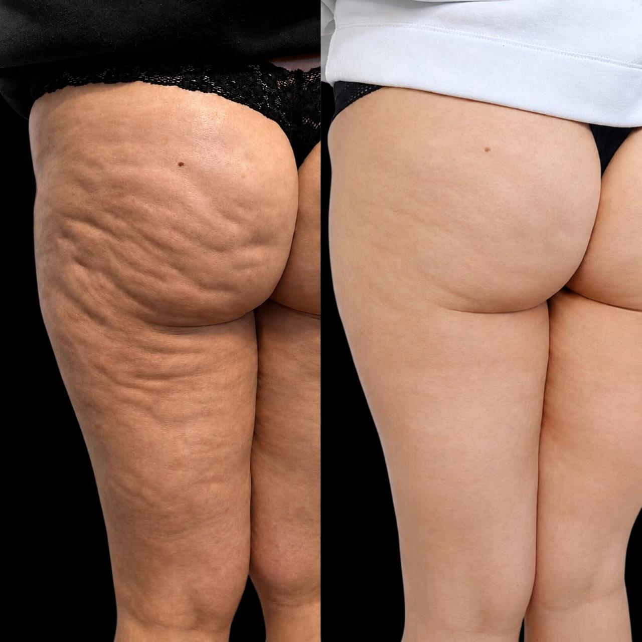 Antes e depois de cuidado corporal em região de coxa e glúteo