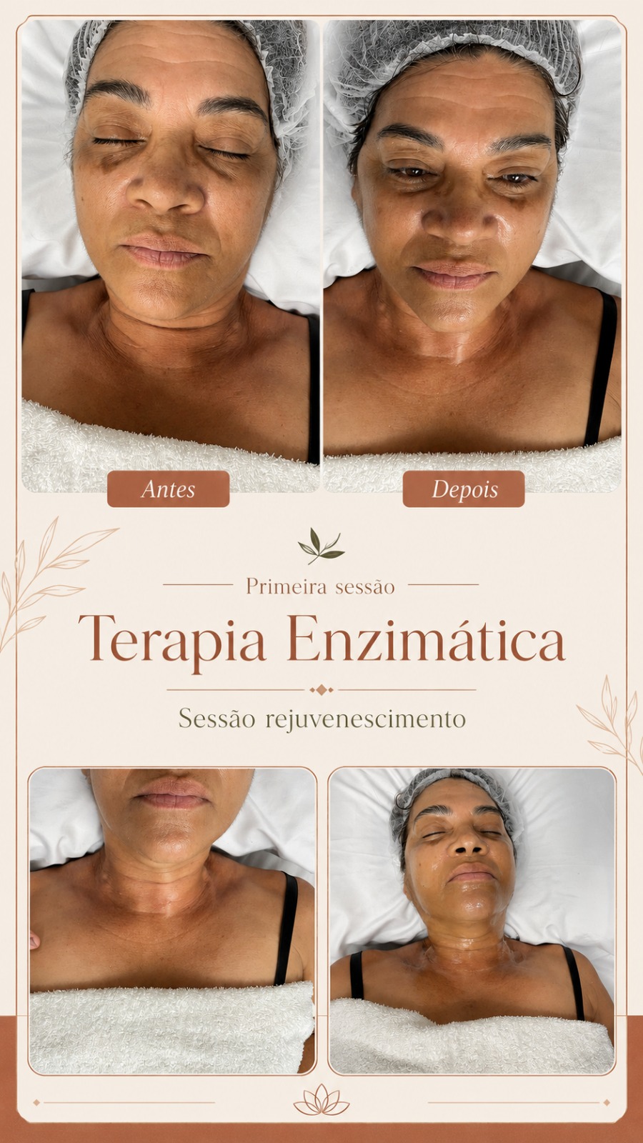 Montagem de antes e depois de terapia enzimática em sessão de rejuvenescimento facial