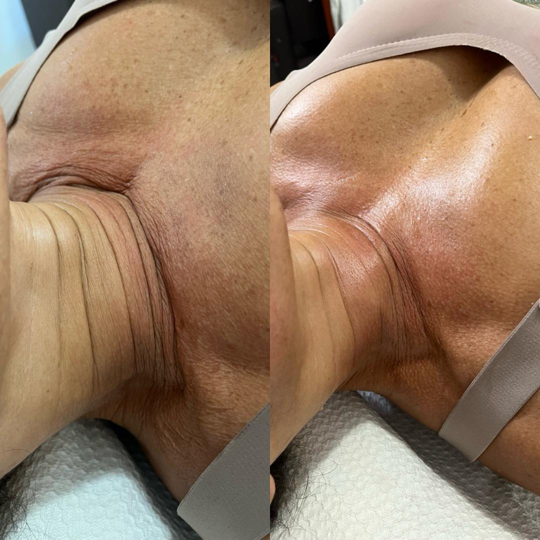 Antes e depois de cuidado em região de colo e pescoço