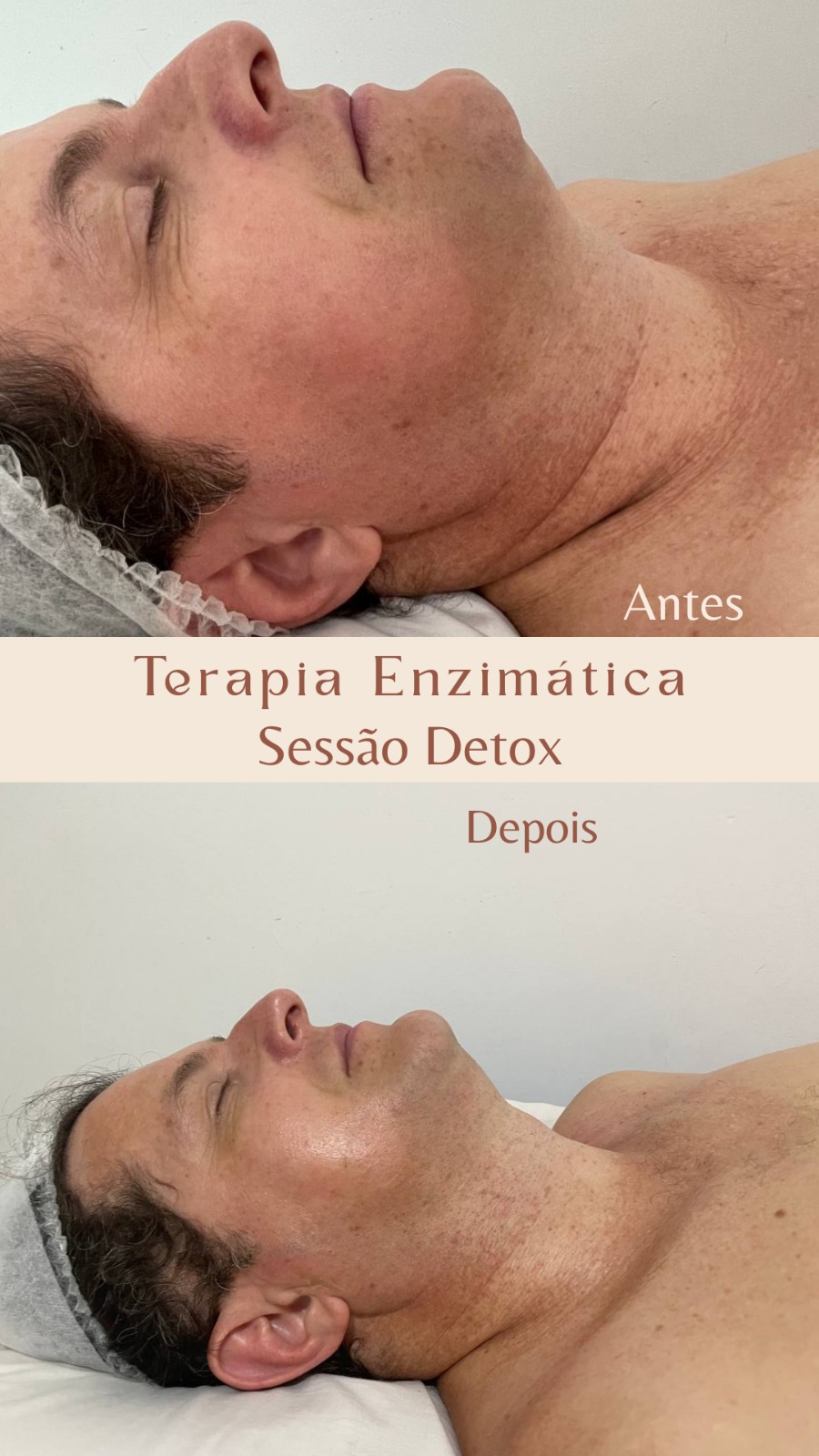 Antes e depois de terapia enzimática em sessão detox facial