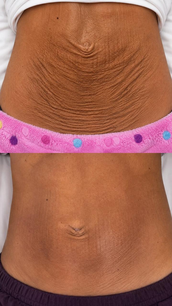 Comparativo antes e depois em região abdominal